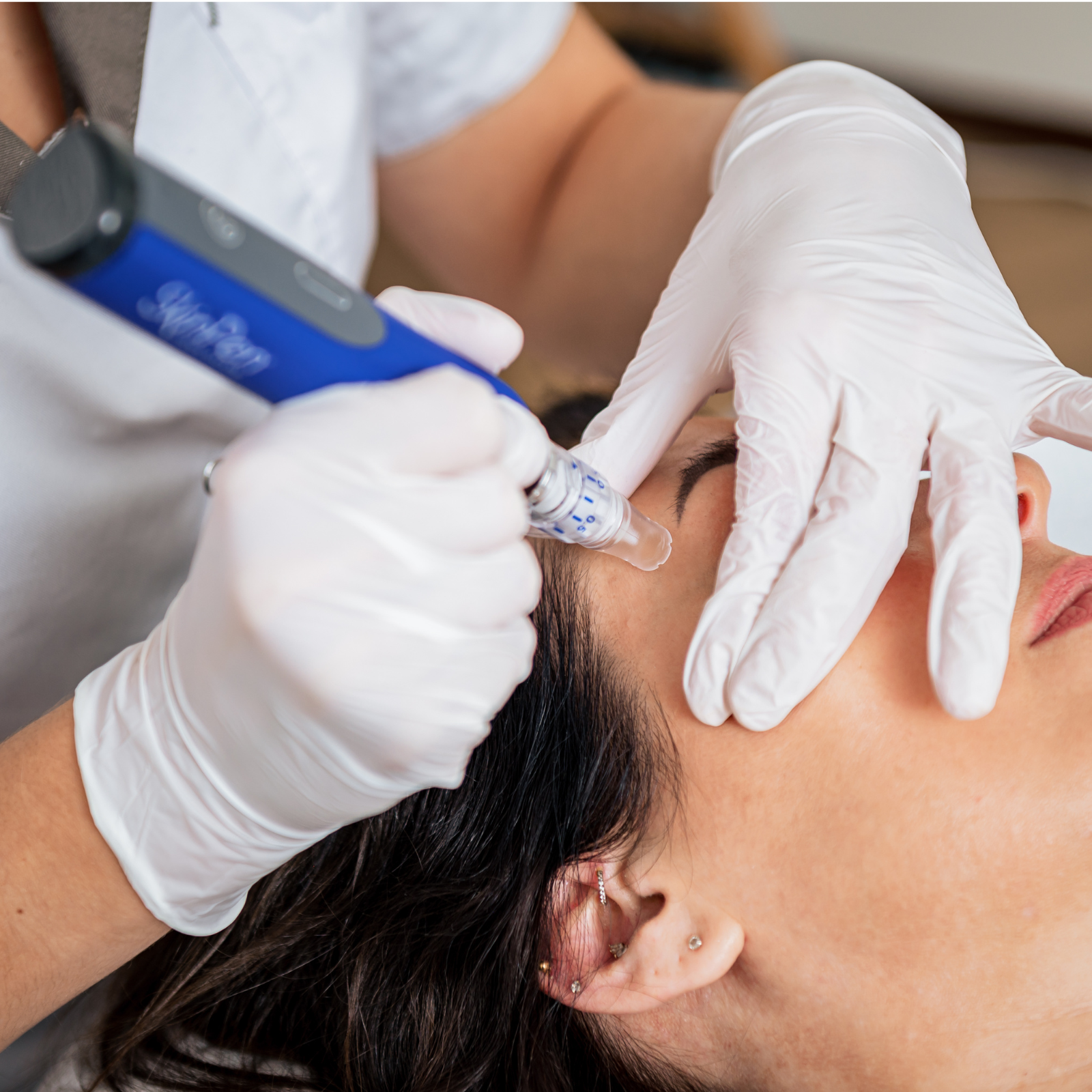 Medische microneedling Medische microneedling